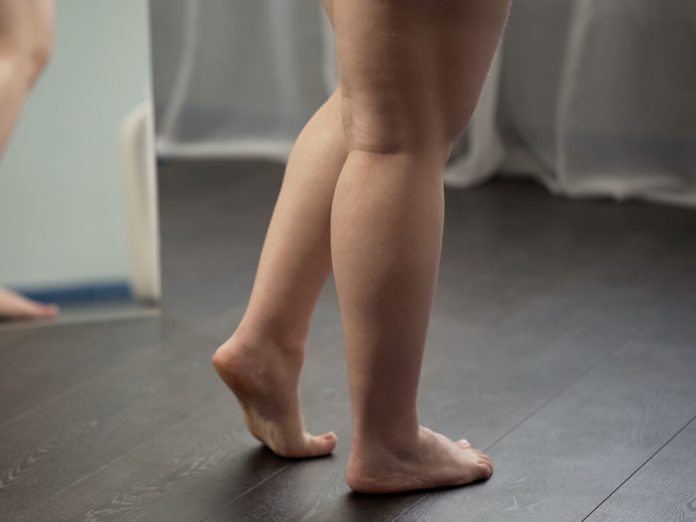 Obese ladys feet, unhealthy woman suffering excess weight and varicose veins