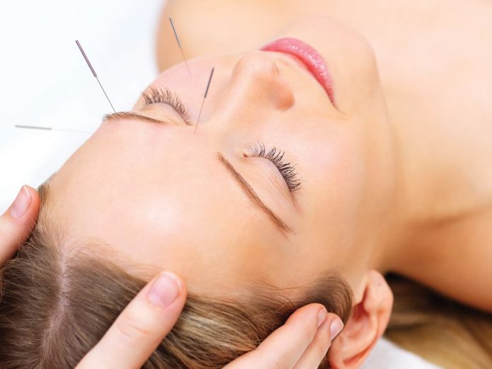Beautiful young woman with eyes closed receiving acupuncture therapy