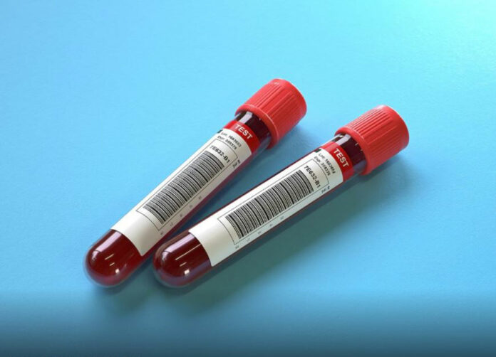 Kanda enfeksiyon nasıl anlaşılır, nasıl geçer? Kana mikrop nasıl bulaşır?