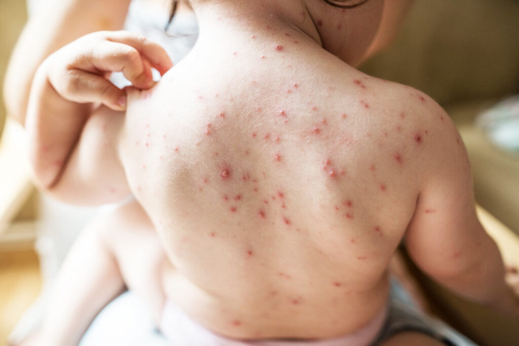 Su çiçeği nasıl olur? Su çiçeği kaşıntısına ne iyi gelir? Bulaşıcı mı?